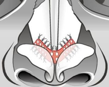 Position of Breathe-Implant on the triangular cartilage (diagram)